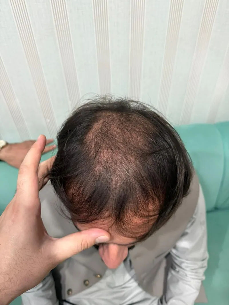 Before Chinese hair treatment — patient case case-chinese-3400-norwood-vi